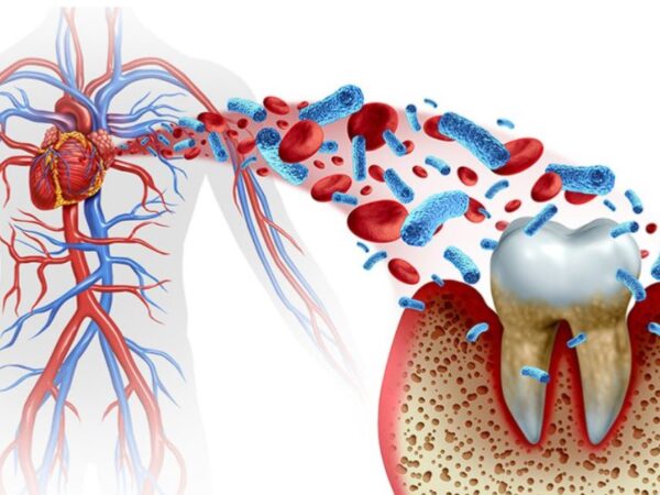 The Interrelation Between Oral Health And Cardiovascular Disease