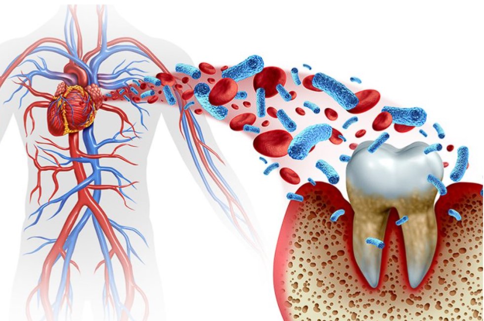 The Interrelation Between Oral Health And Cardiovascular Disease